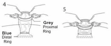 Disposable Wound Retractor for Laparoscopic Surgery